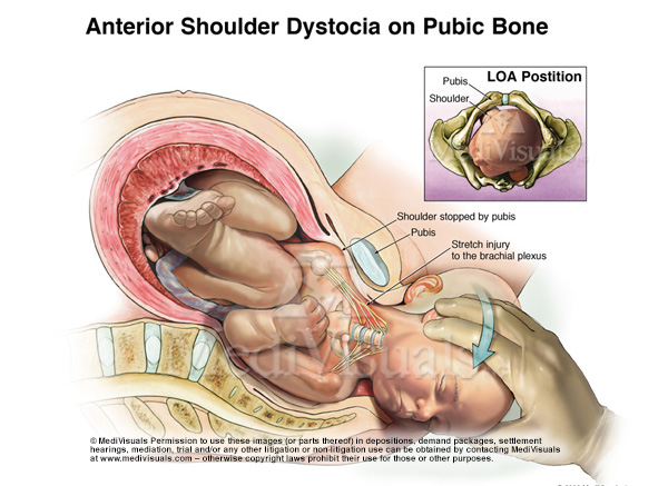 Understanding the Brachial Plexus Injury: Part 2 (Shoulder Dystocia)