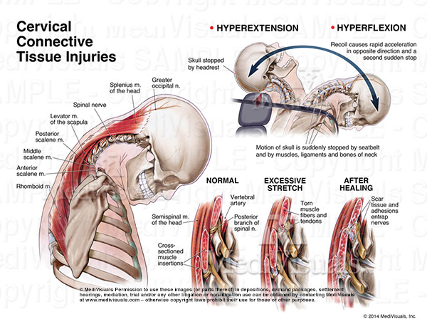 Cervical Connective Tissue Injury (a.k.a. “Whiplash,” “Cervical Soft Tissue Injury,” and “Cervical Strain and/or Sprain”)