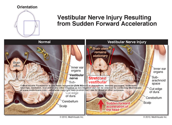 Vestibular Nerve Injury: Why it could be important to your TBI case