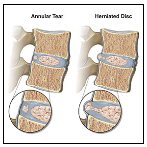 Annular Tears and Fissures (Intervertebral Disc Pathology, Part 2 of 3)