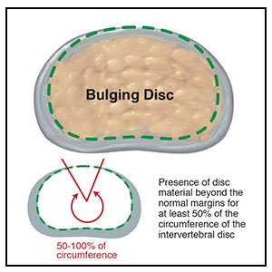 How a Disc “Bulge” is Different From a “Herniation” (Intervertebral Disc Pathology, Part 1 of 3)