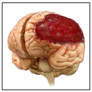 Understanding Traumatic Brain Injuries: Mild (less severe) to Severe – Part 1