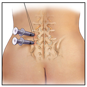 “Minimally Invasive” Spine Treatments: Discography, Injections & Ablation