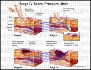 Pressure Ulcer Stages - Medivisuals Inc.