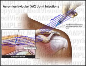 Acromioclavicular (AC) Joint Injections - Medivisuals Inc.