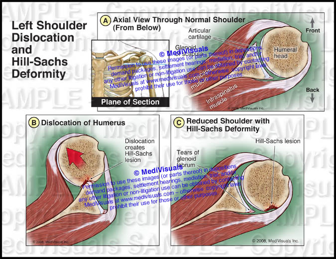 Left Shoulder Dislocation and Hill-Sachs Deformity | Medivisuals Inc.