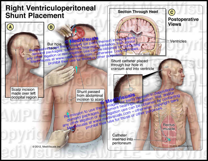 a) Ventriculoperitoneal shunt chamber along with the peritoneal