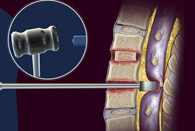 Medical Legal Animations | Visualizing Medical Concepts | Medivisuals Inc.